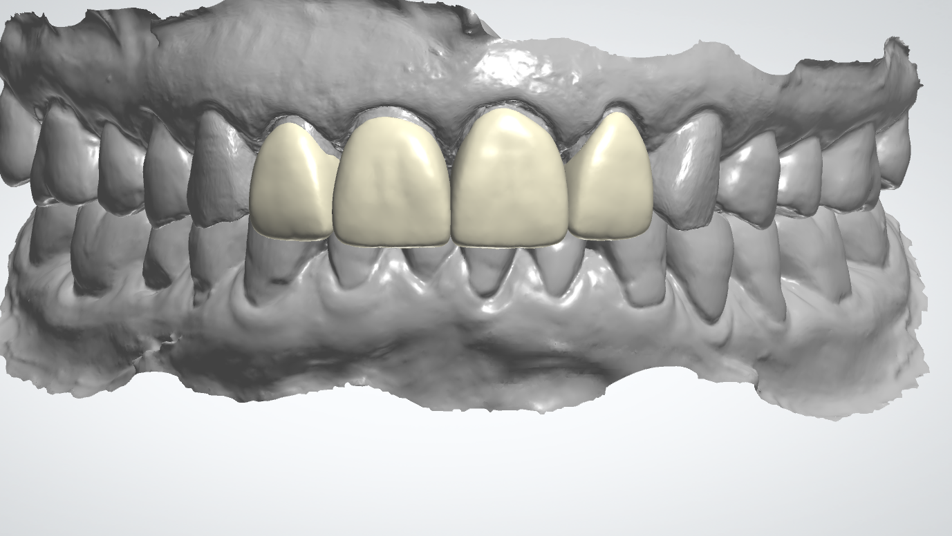 4 Units Anterior Crown Design
